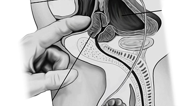 doigtage de la prostate