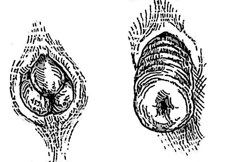 protrusion anale